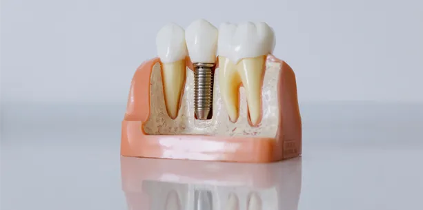 Diş Kemiğinde Diş Implant Fotoğrafı
